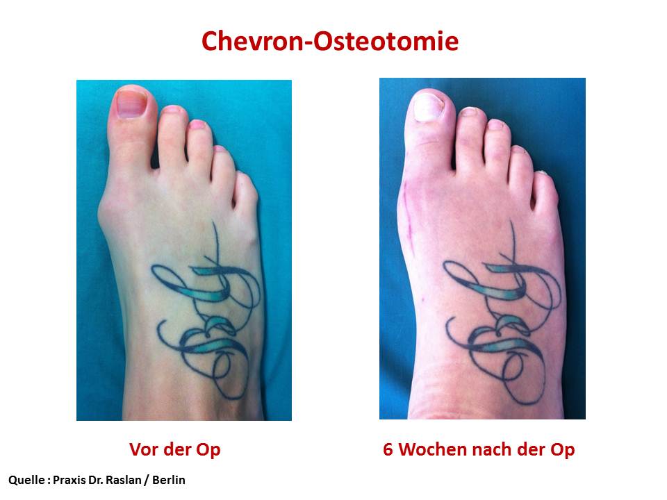 Beispiel 2 Chevronosteotomie -Hallux halgus Dr Raslan