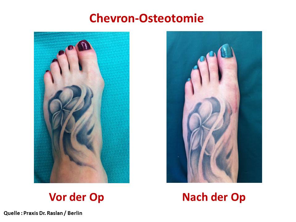 Beispiel Chevronosteotomie -Hallux halgus Dr Raslan