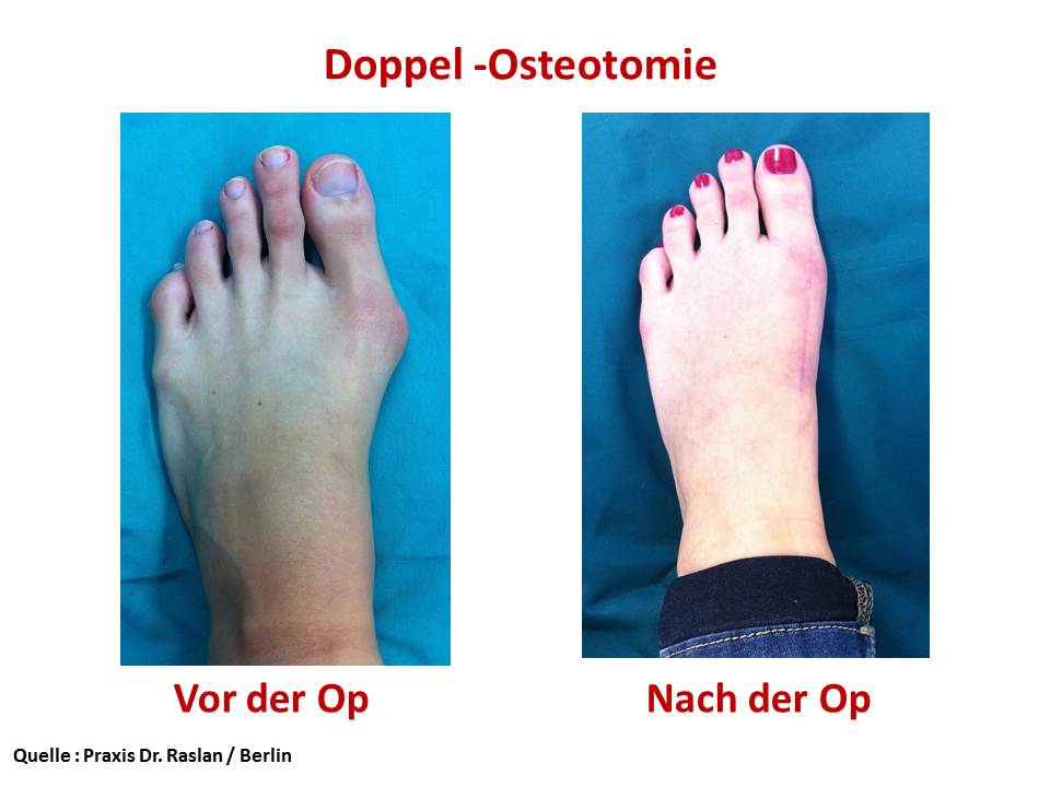 Beispiel Doppel Osteotomie