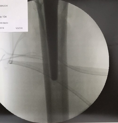 Coxarthrose Hüftkopfnekrose Hüft TEP Hüft spezialist Dr Raslan Berlin Hüftendoprothese Kopie