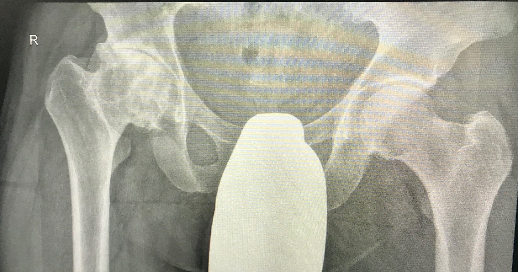 Coxarthrose Hüftkopfnekrose Hüft TEP Hüft spezialist Dr Raslan Berlin Hüftendoprothese 5480