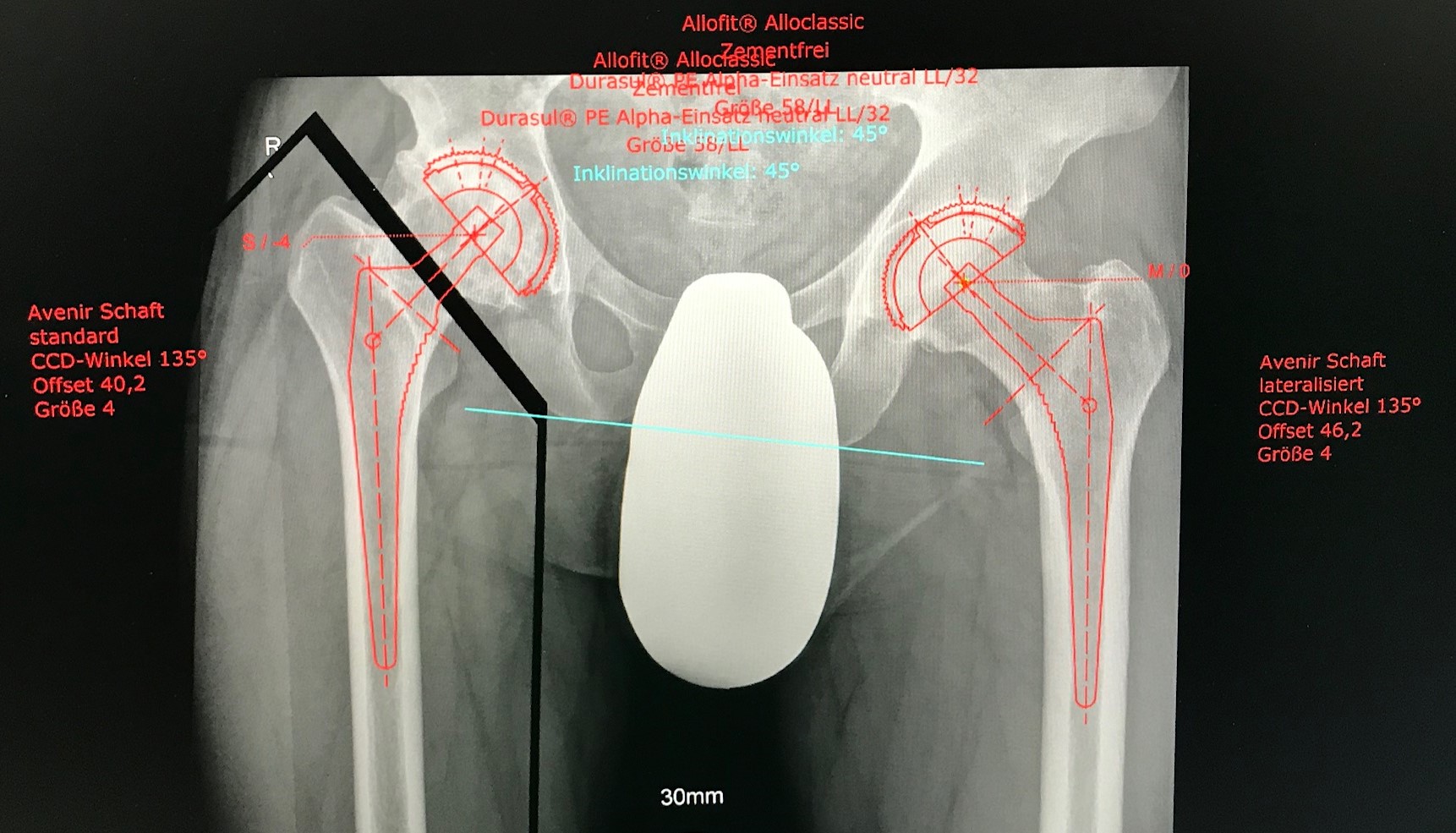 Coxarthrose Hüftkopfnekrose Hüft TEP Hüft spezialist Dr Raslan Berlin Hüftendoprothese 5481