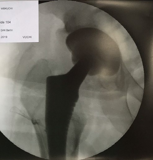 Coxarthrose Hüftkopfnekrose Hüft TEP Hüft spezialist Dr Raslan Berlin Hüftendoprothese 5608