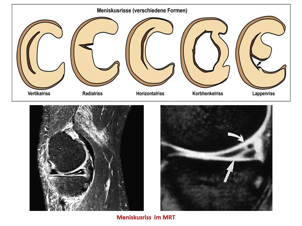 Formen Meniskusriss