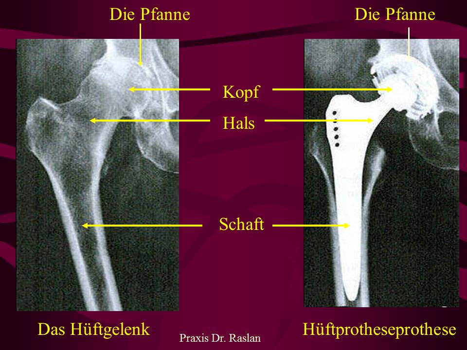 Hüft TEP 2