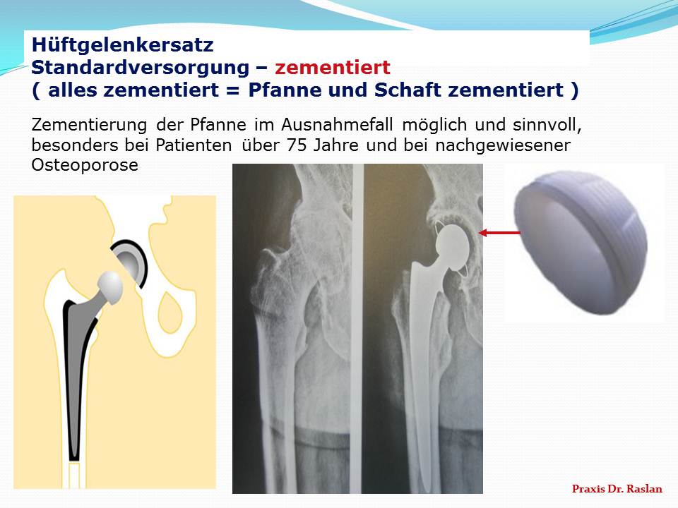 Hüftgelenkersatz zementiert