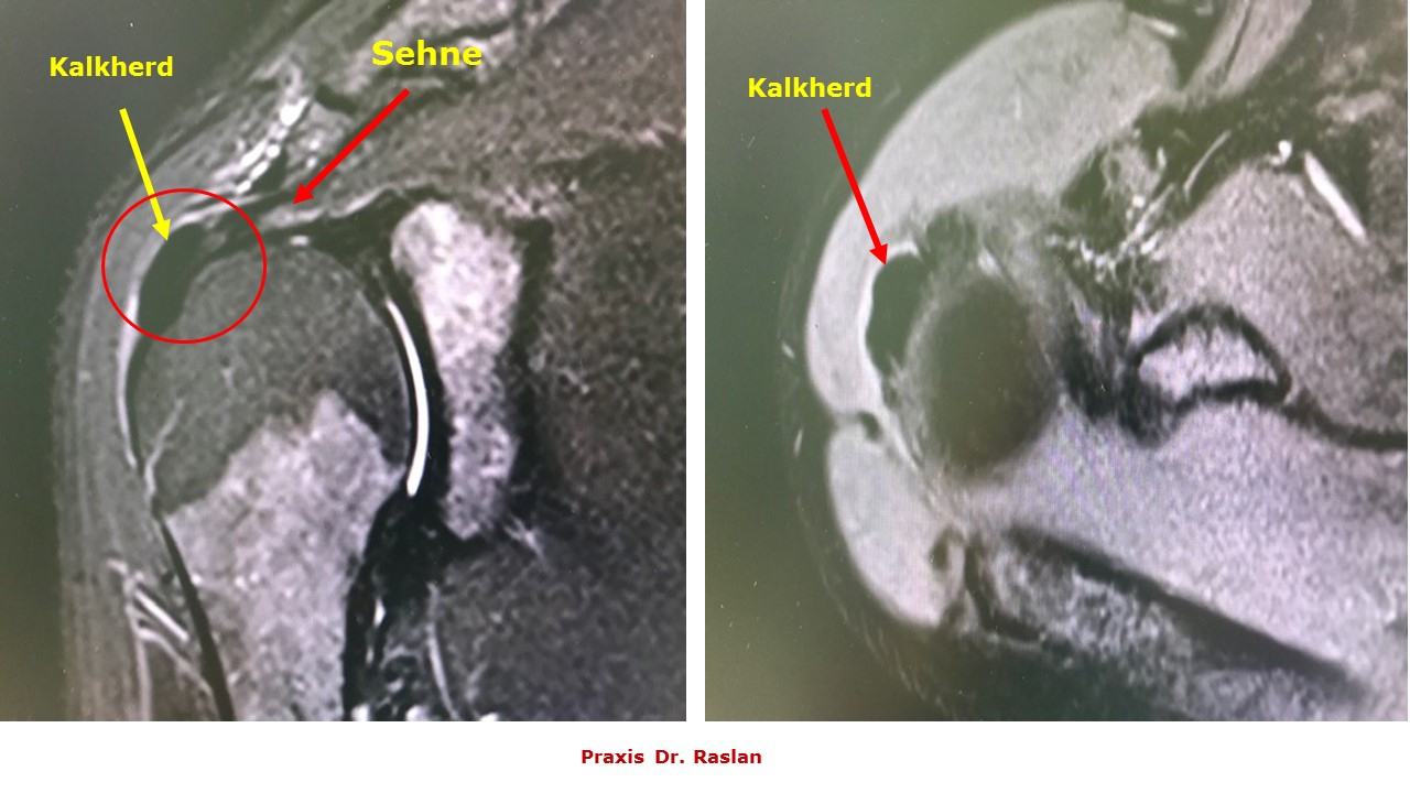 Kalkschulter Dr Raslan Orthopäde Schulterspezialist Berlin 1 