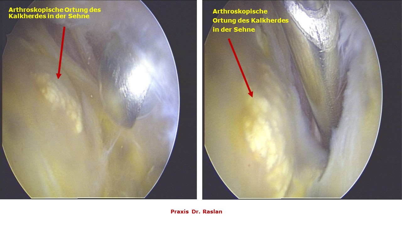 Kalkschulter Dr Raslan Orthopäde Schulterspezialist Berlin 2 