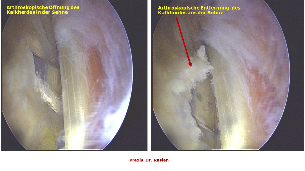 Kalkschulter Dr Raslan Orthopäde Schulterspezialist Berlin 3