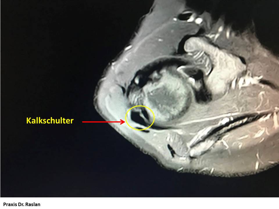 Kalkschulter Schulterspezielist Berlin Dr Raslan Kniespezialist Dr Raslan Berlin Fußspezielist Dr Raslan Berlin Orthopäde Berlin