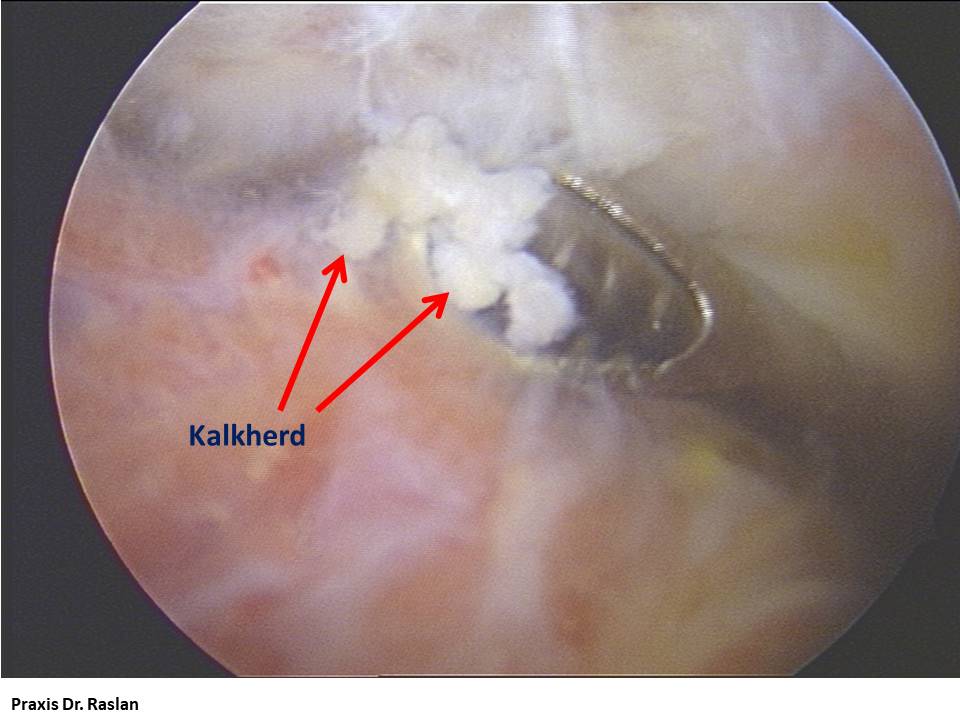 Kalkschulter Schulterspezielist Berlin Dr Raslan Kniespezialist Dr Raslan Berlin Fußspezielist Dr Raslan Berlin Orthopäde Berlin 000