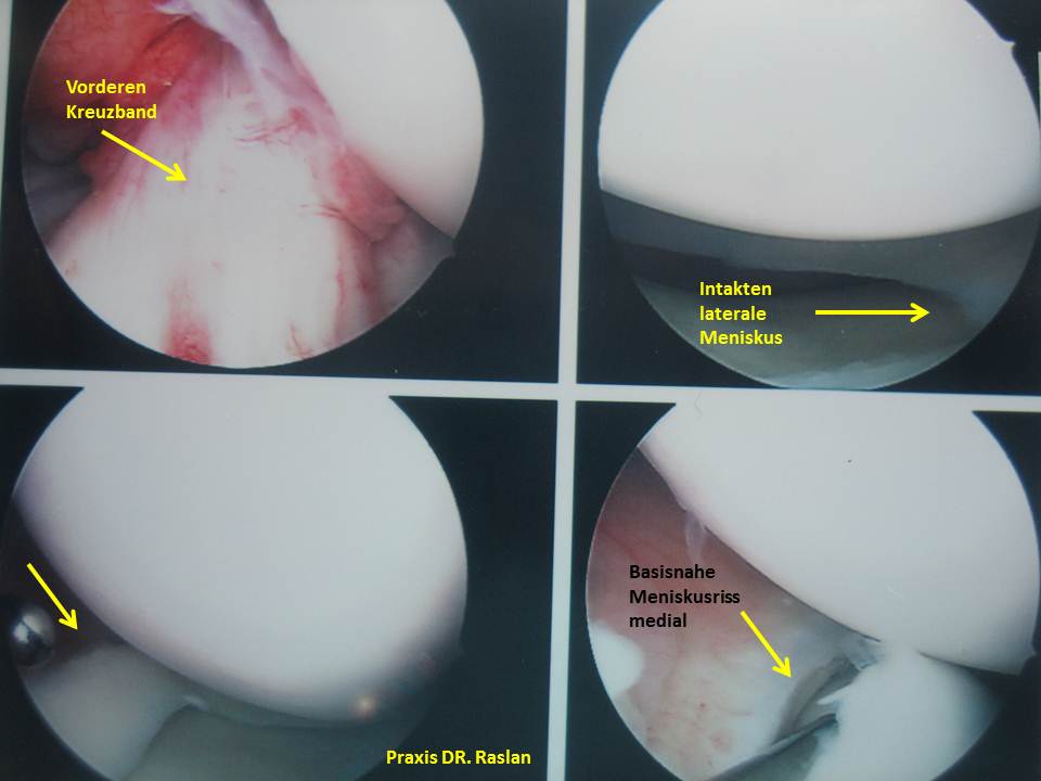 Meniskusriss 1