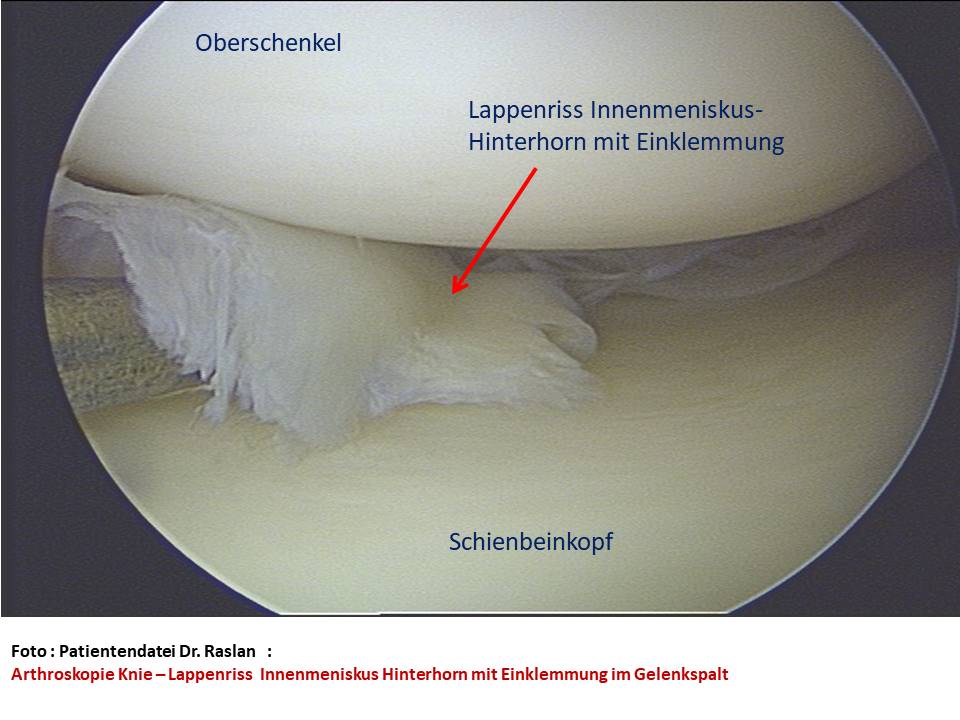 Meniskusriss Lappenriss Orthopäde Berlin Dr Raslan Kreuzbands Berlin Kniespezialist Orthopäde Berlin