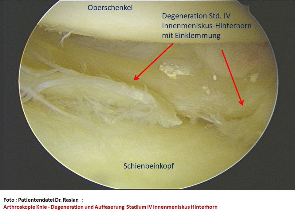 Meniskusriss Meniskusdegeneration Orthopäde Berlin Dr Raslan Kreuzbands Berlin Kniespezialist Kniearthroskopie Orthopäde Berlin