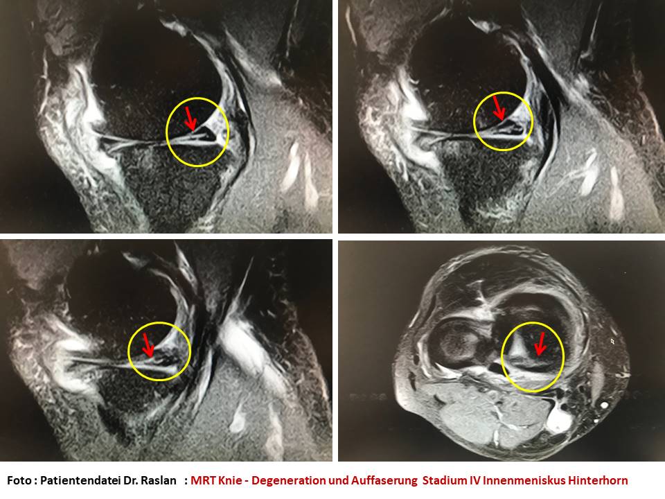 Meniskusriss Meniskusdegeneration Orthopäde Berlin Dr Raslan Kreuzbands Berlin Kniespezialist Orthopäde Berlin MRT