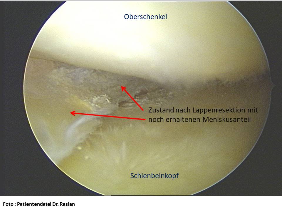 Meniskusriss Orthopäde Berlin Dr Raslan Kreuzbands Berlin Kniespezialist Orthopäde Berlin 3