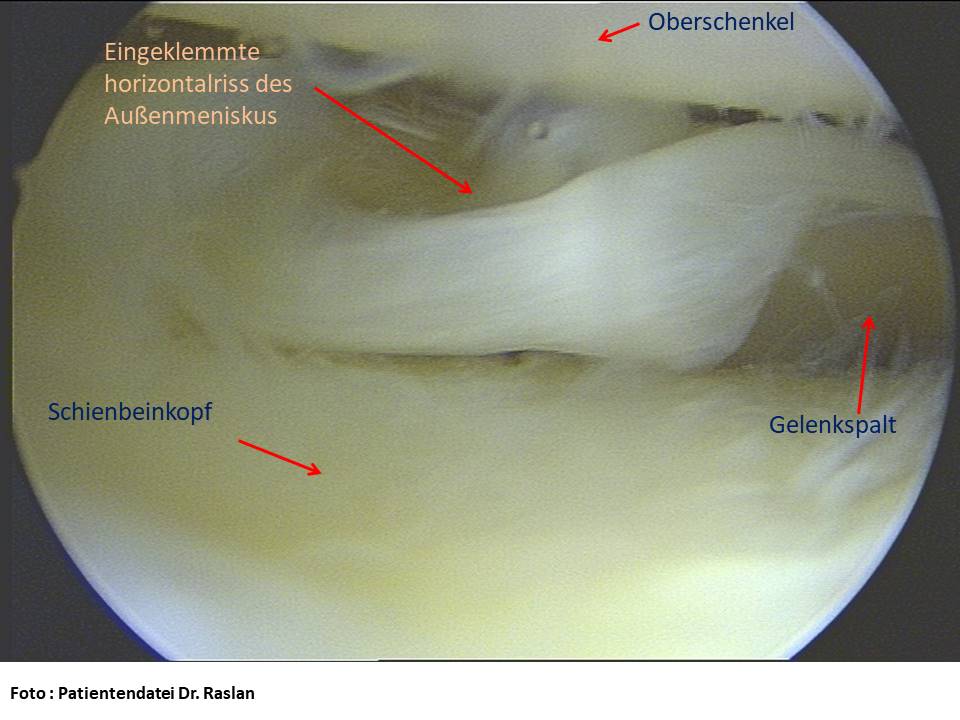 Meniskusriss horizontal Orthopäde Berlin Dr Raslan Kreuzbands Berlin Kniespezialist Orthopäde Berlin