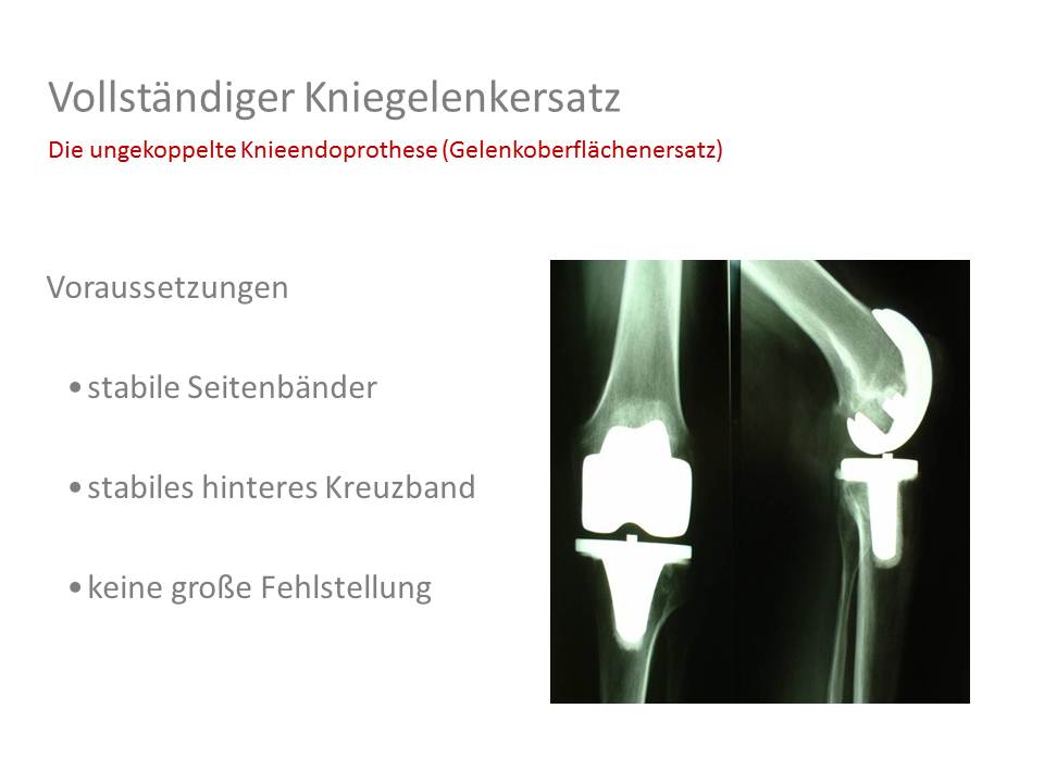 Oberflächen Knieersatz