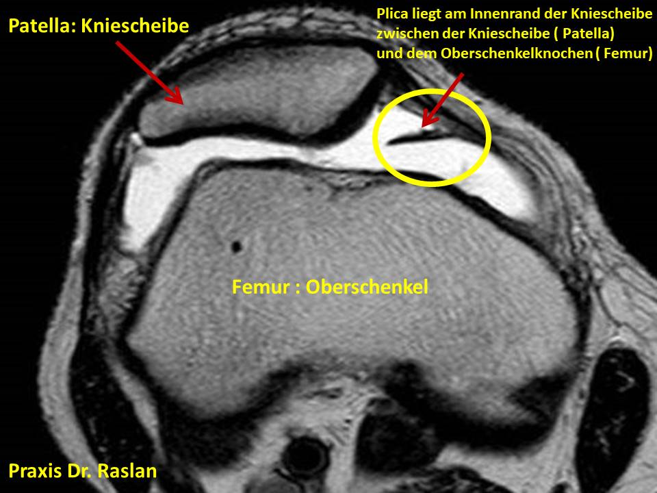 PLicasyndrom Orthopäde Berlin Dr Raslan Kniespezialist Kreuzbandspezialist Meniskusspezialist 1