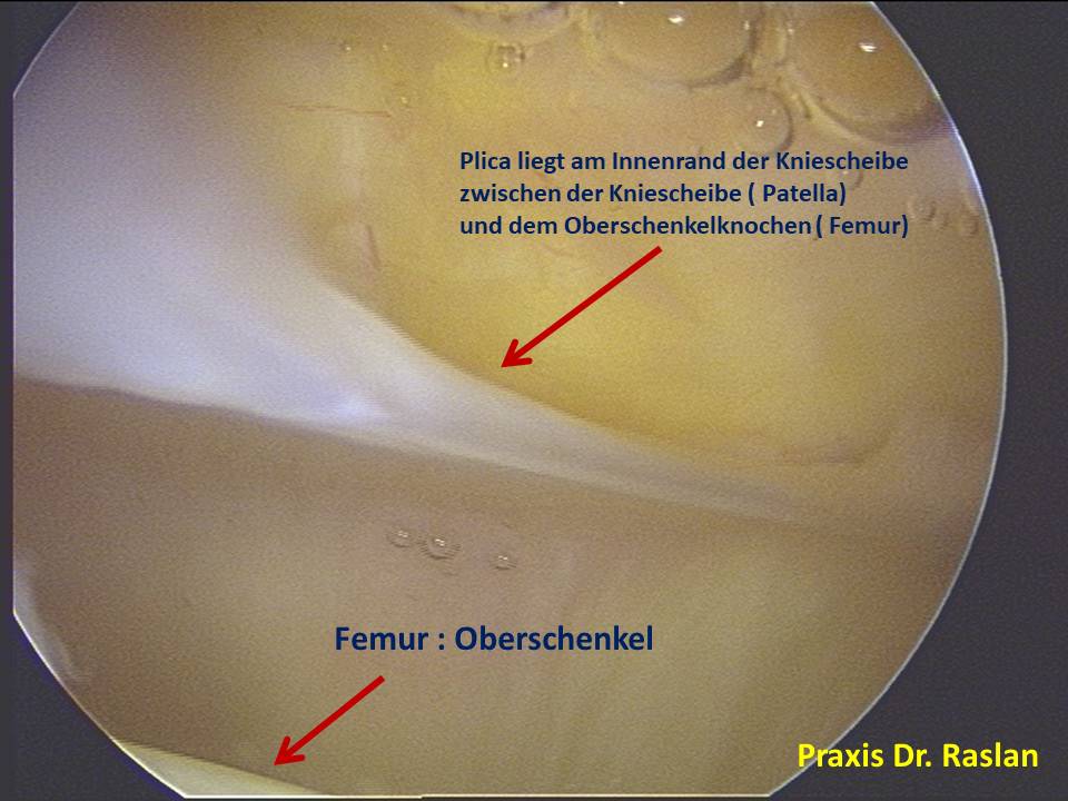 PLicasyndrom Orthopäde Berlin Dr Raslan Kniespezialist Kreuzbandspezialist Meniskusspezialist 2 1