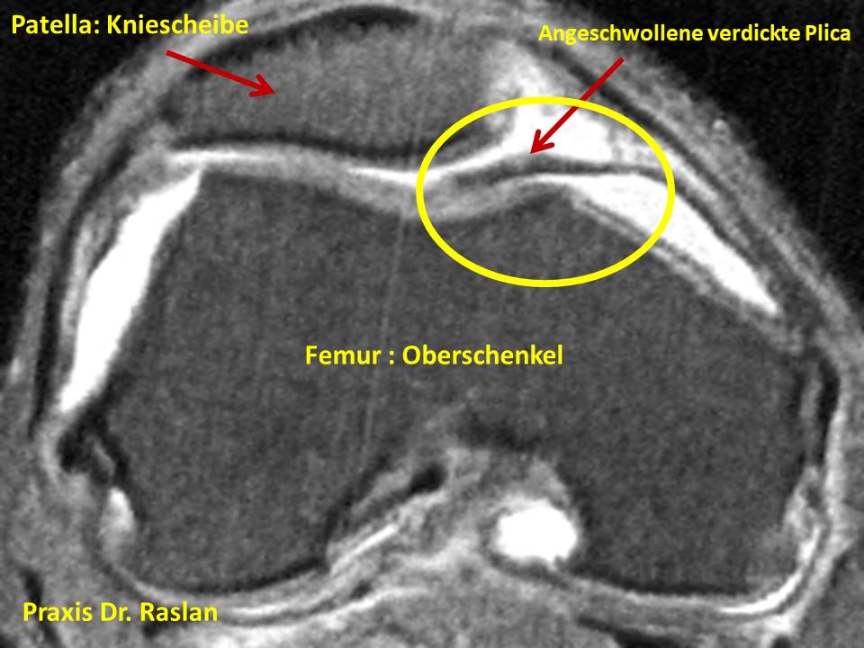 PLicasyndrom Orthopäde Berlin Dr Raslan Kniespezialist Kreuzbandspezialist Meniskusspezialist 2 2