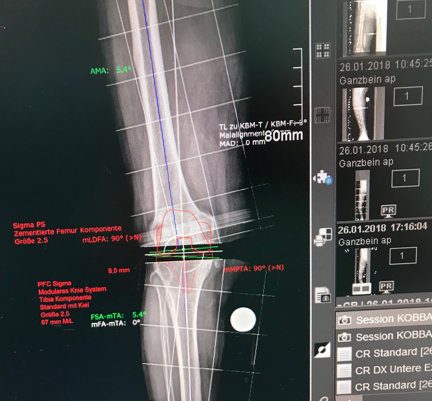 Plannung Knie endoprothese DR Raslan Orthopäde Kniespezialist Berlin 2