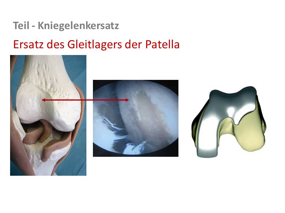 Retropatellarersatz