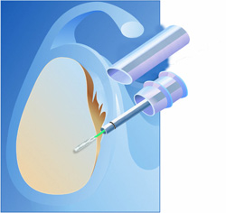 abb046aLabrumrefixation Arthrex 3