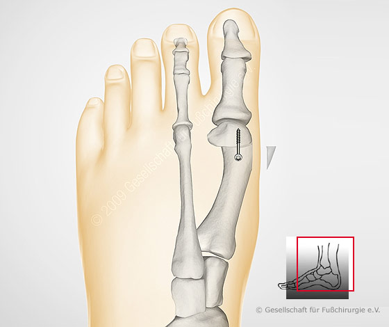 hallux-valgus-op-nach-austin-chevron-gross