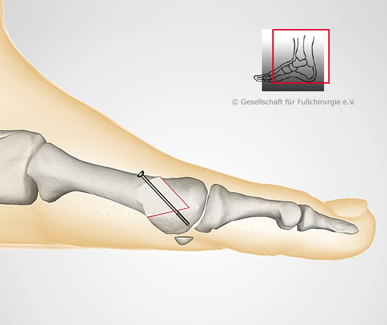 hallux-valgus-op-nach-austin-chevron2-gross