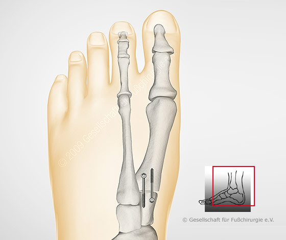 hallux-valgus-op-nach-lapdus2-gross