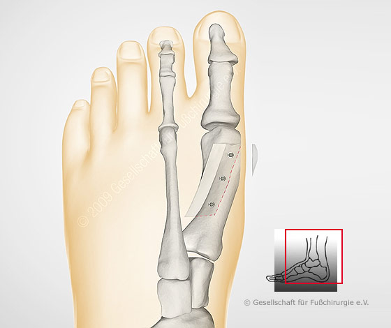 hallux-valgus-op-nach-meyer-scarf-gross