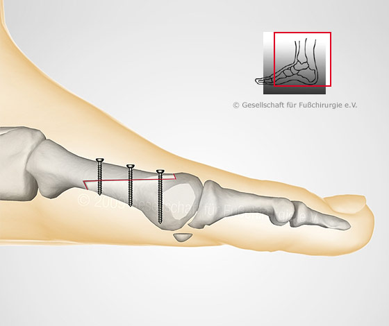 hallux-valgus-op-nach-meyer-scarf2-gross