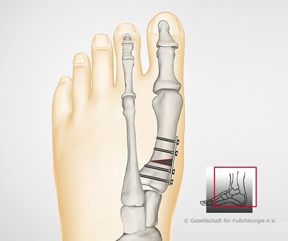 hallux-valgus-umstellungs-op2-gross