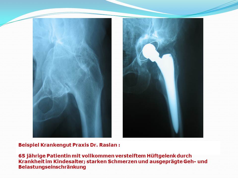 künstliche Hüftgelenk Dr Raslan