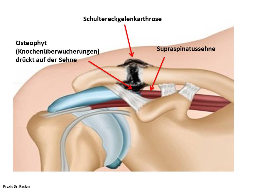 Teilentfernung Schultereckgelenk Ac Gelenkresektion
