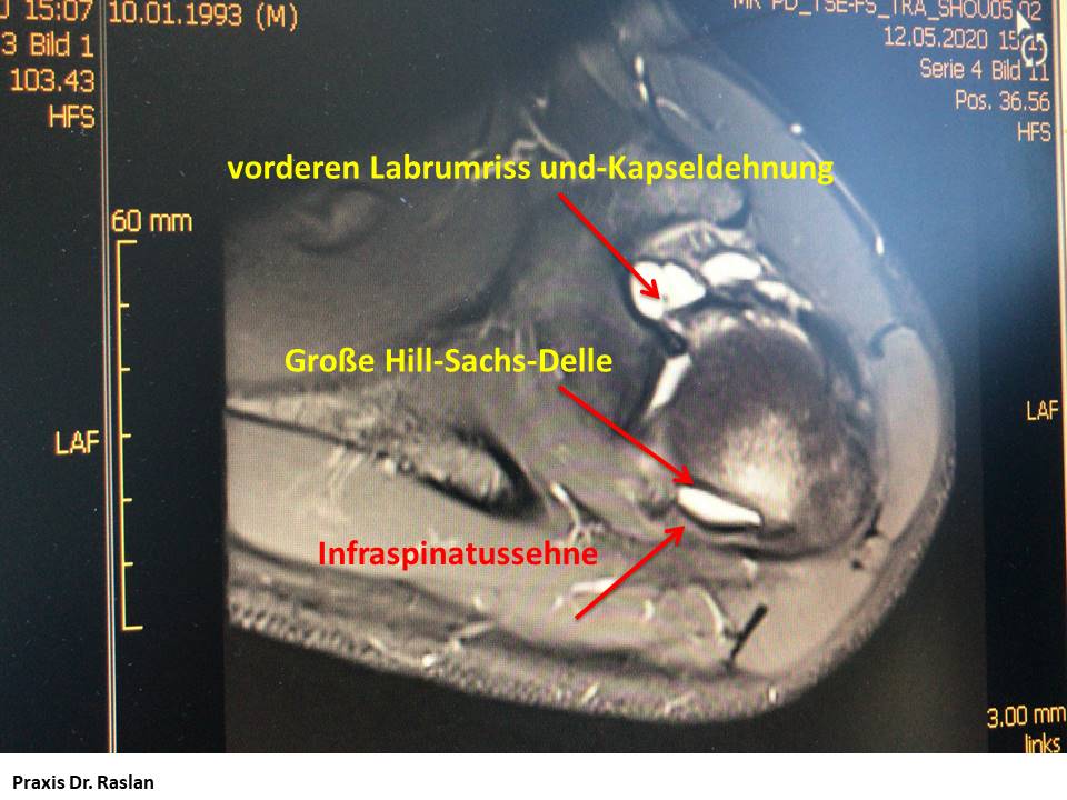 orthopäde Berlin Dr Raslan Schulterspezielist ACG Arthrose Berlin Dr Raslan Kniespezialist Dr Raslan Berlin Fußspezielist Dr Raslan Berlin Hill Sachs Delle